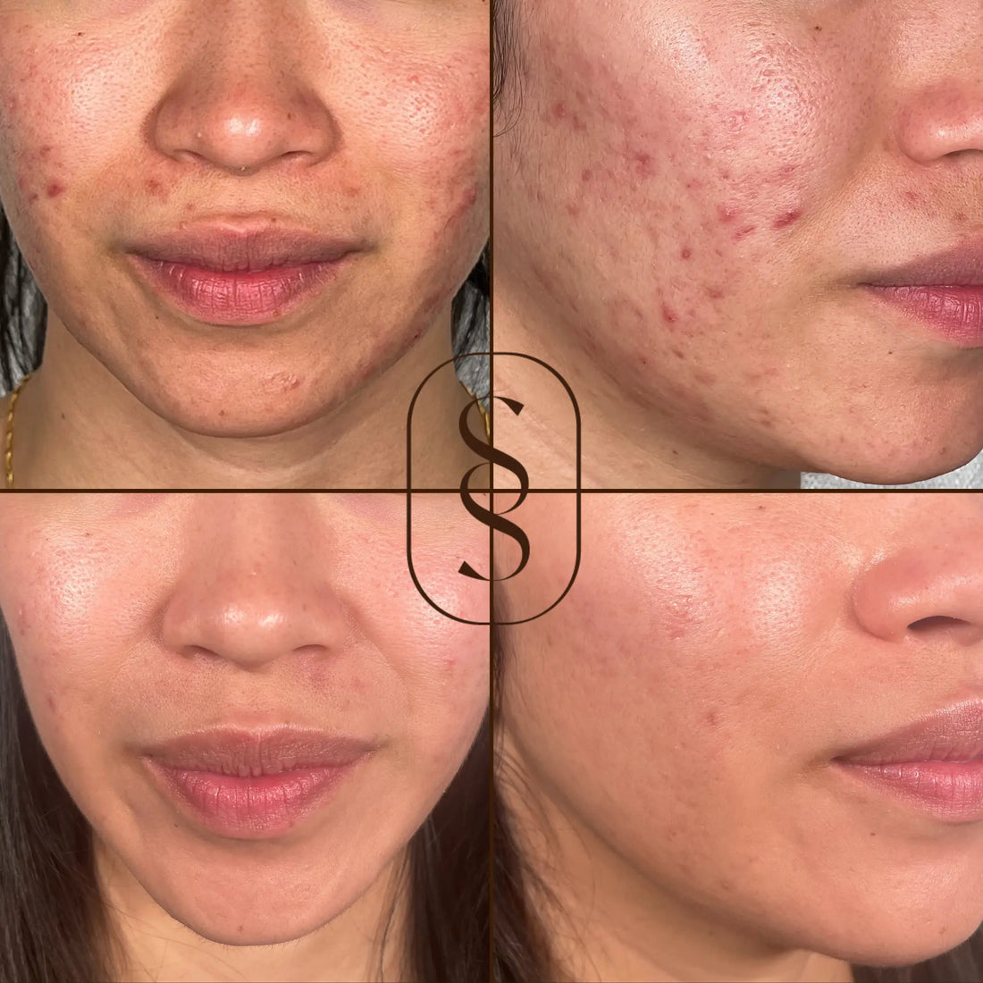 Clear-Skin-Goals-Combat-Acne-and-Hyperpigmentation-with-the-Plasma-Skin-Perfector Skin Skulpt