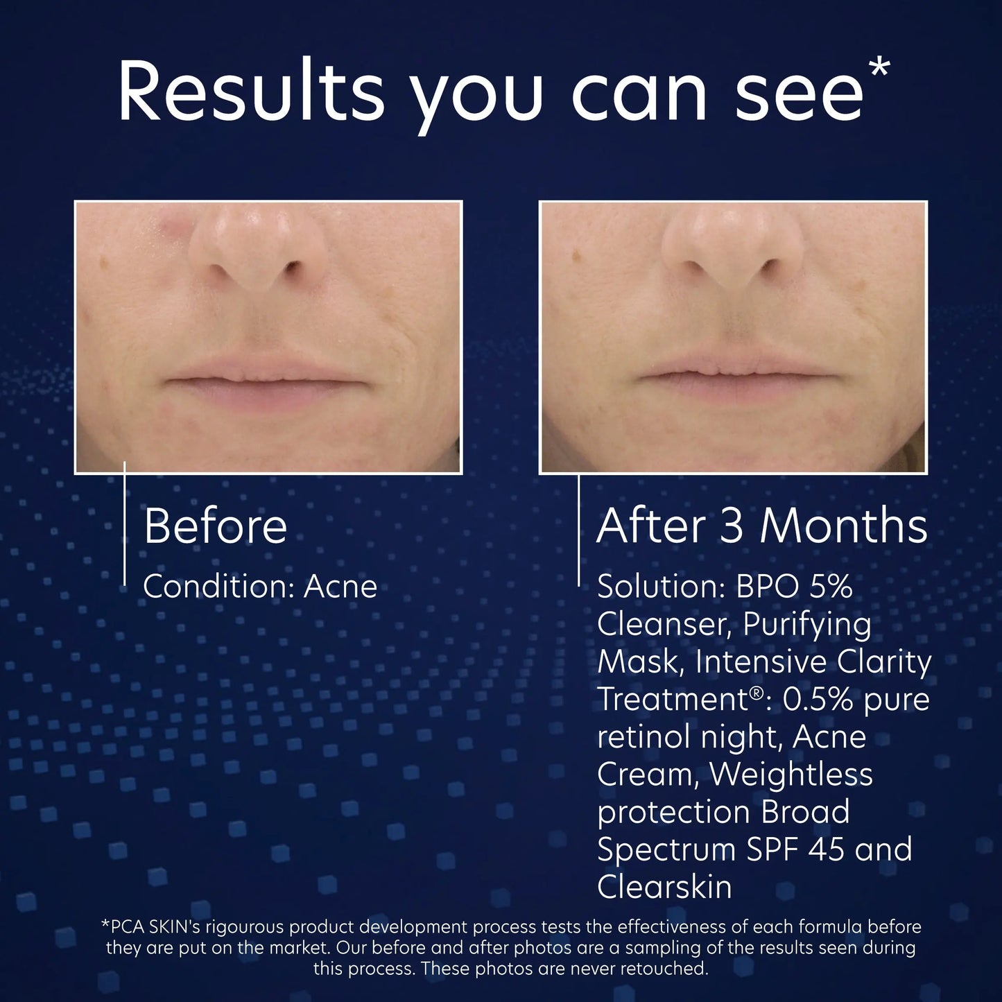 Before and after using PCA BPO 5% Cleanser for acne, from SkinSkulpt