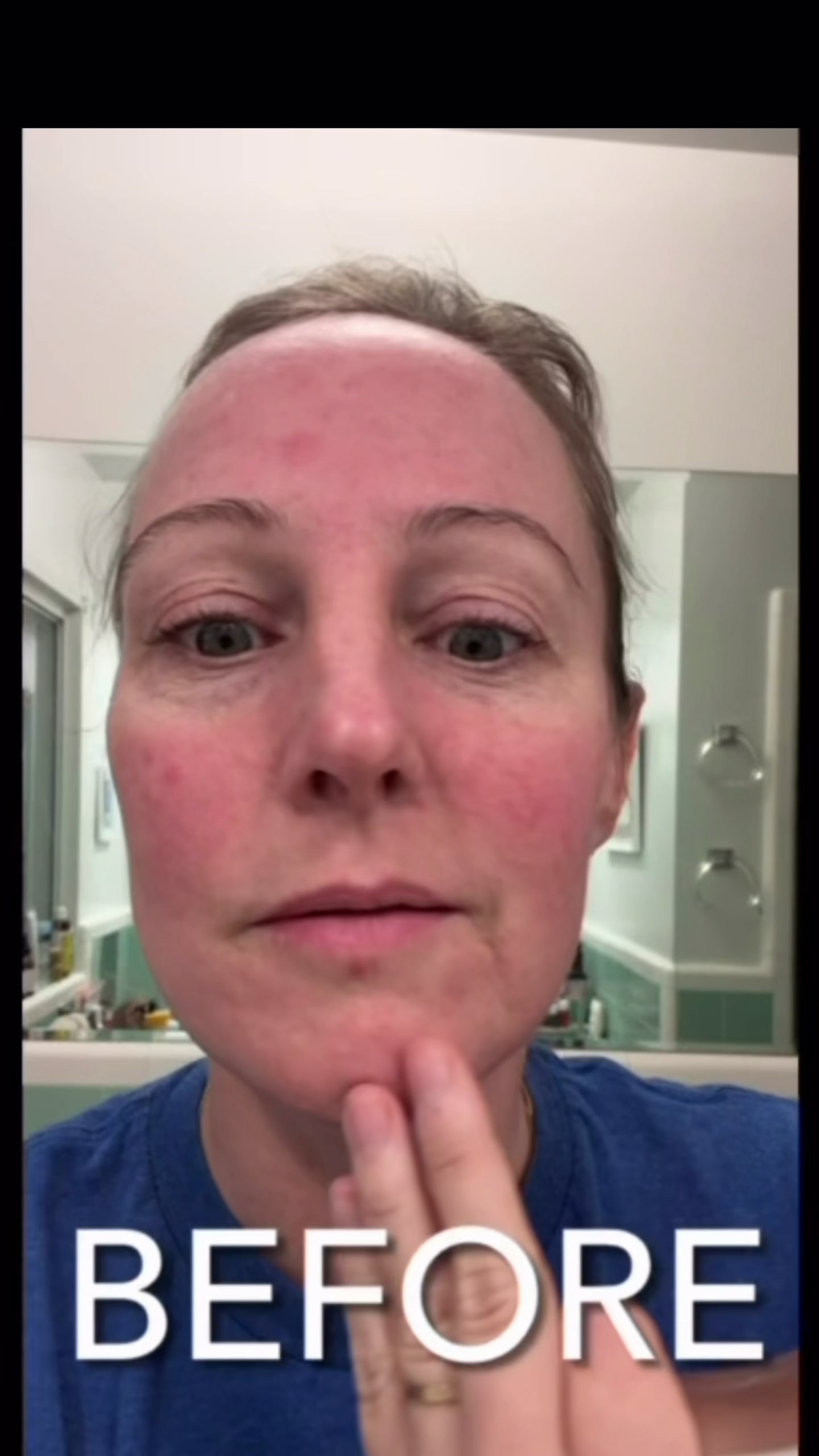 Plasma Skin Perfector